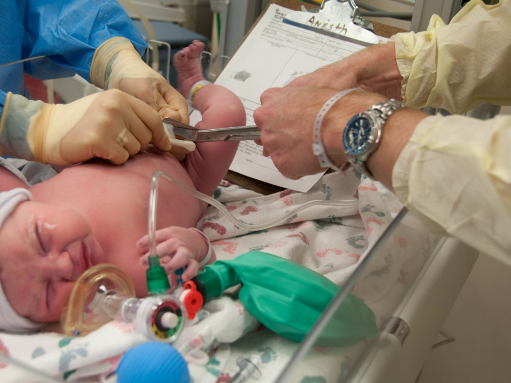 Delayed Cord Clamping After Birth Pink & Blue LA